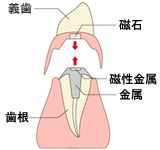 マグネット式義歯
